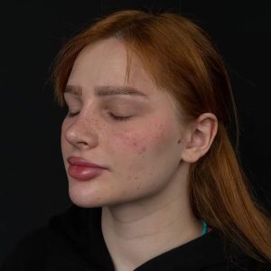 Ринопластика кончика носа в Москве