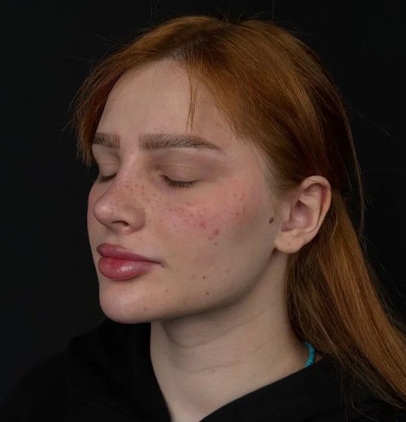 Ринопластика кончика носа в Москве