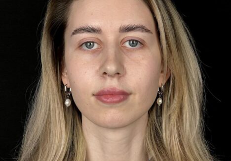 Риносептопластика в Москве