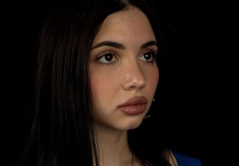 Хирургическое лечение птоза века в Москве