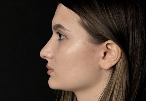 Ринопластика в Москве