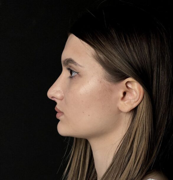 Ринопластика в Москве