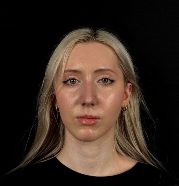 Уменьшение носа в Москве