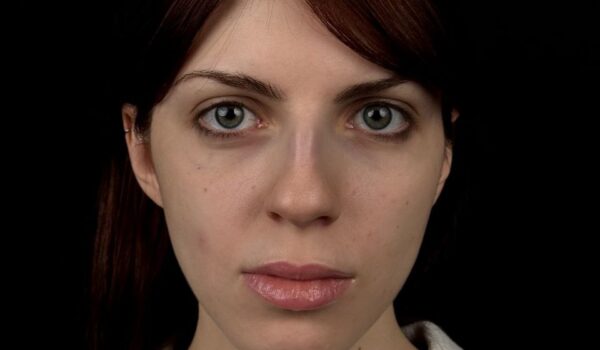 Ринопластика крыльев носа в Москве