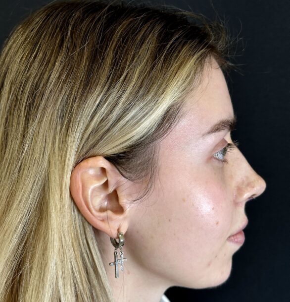 Закрытая ринопластика носа в Москве