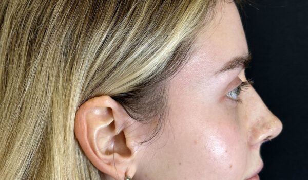 Закрытая ринопластика носа в Москве