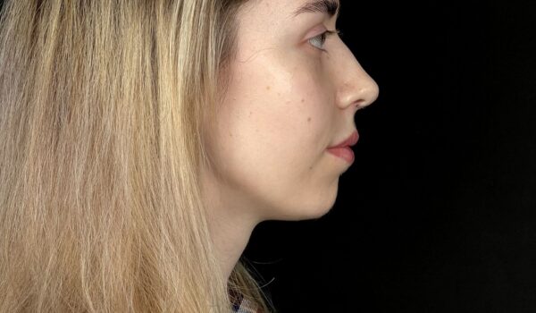 Лазерная ринопластика в Москве