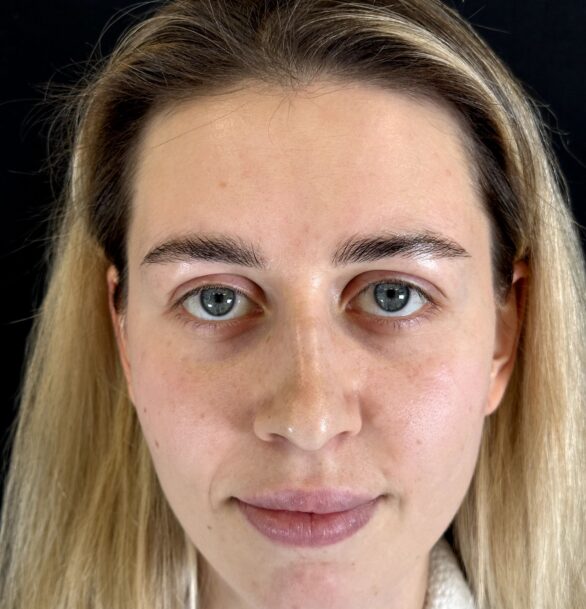 Круговая блефаропластика в Москве