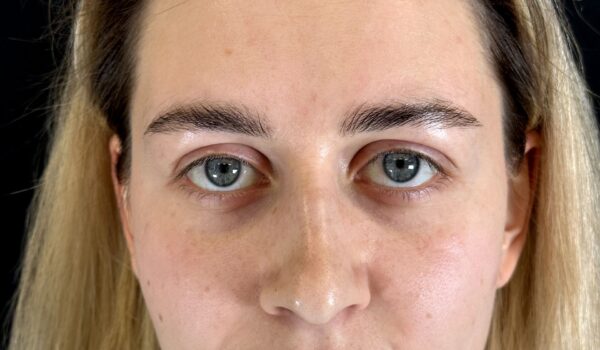 Круговая блефаропластика в Москве