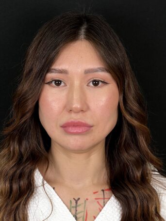 Ринопластика широкого носа в Москве