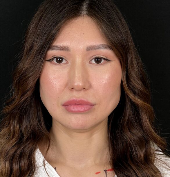 Ринопластика широкого носа в Москве