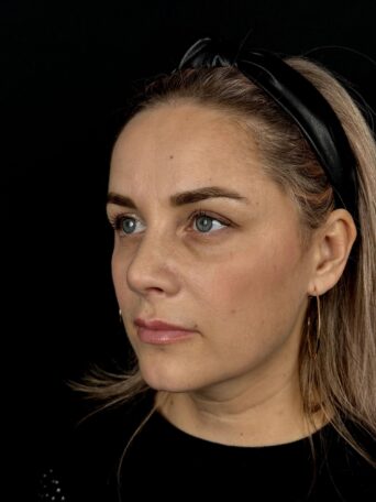 Блефаропластика мешков под глазами в Москве