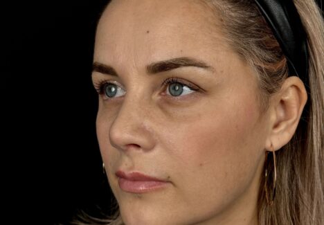 Блефаропластика мешков под глазами в Москве