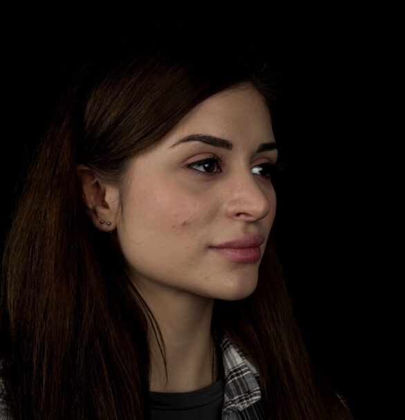 Повторная ринопластика в Москве