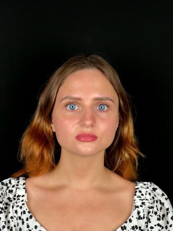 Открытая ринопластика в Москве