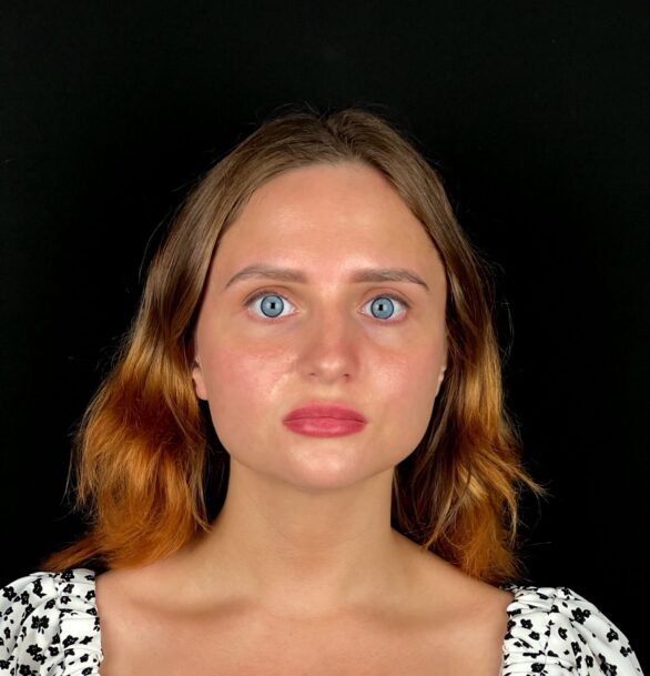 Открытая ринопластика в Москве