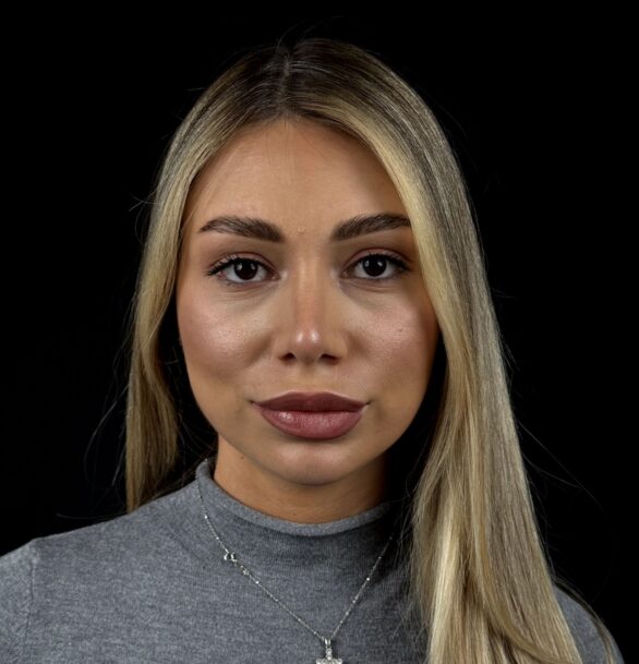 Ринопластика ноздрей в Москве