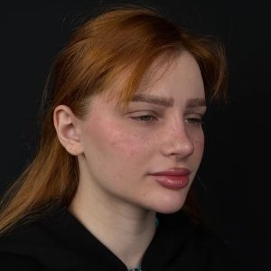 Лазерная септопластика