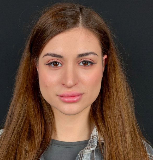 Височная блефаропластика в Москве